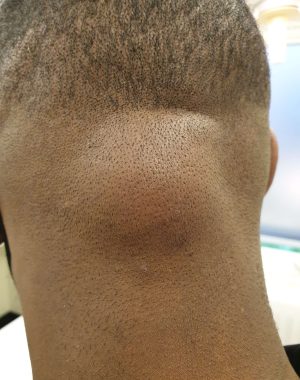 image of a Large Lipoma back of head / neck