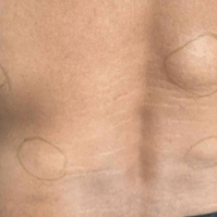 Image of several larger Lipomas on the back