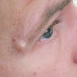 image of a cyst at the side of the right eye