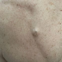 Image of a cyst on the back
