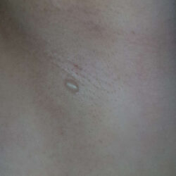 Image of a small armpit cyst
