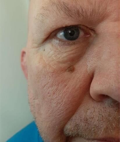 Face wart before removal